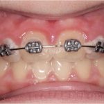 Fig. 9B Dopo 9 mesi dall’inizio del trattamento ortodontico