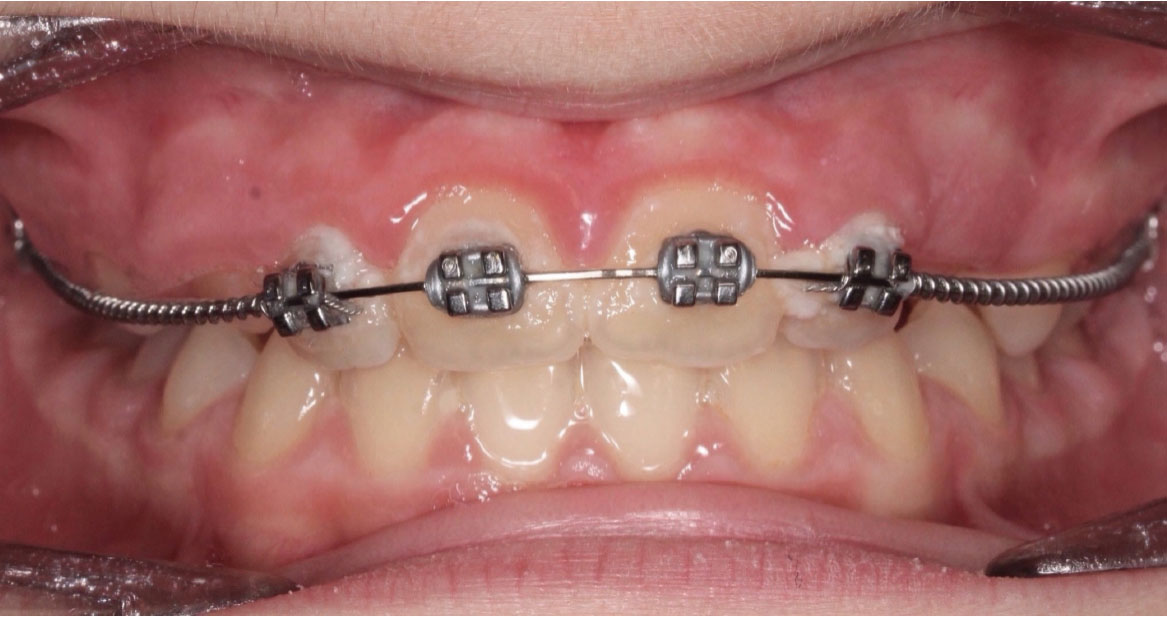 Fig. 9B Dopo 9 mesi dall'inizio del trattamento ortodontico