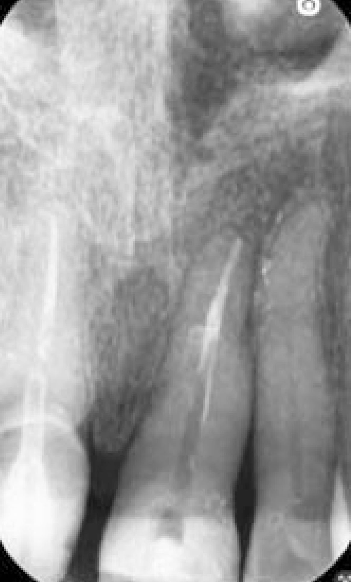 Fig. 8G Terapia canalare di elemento 2.1.: RX finale.