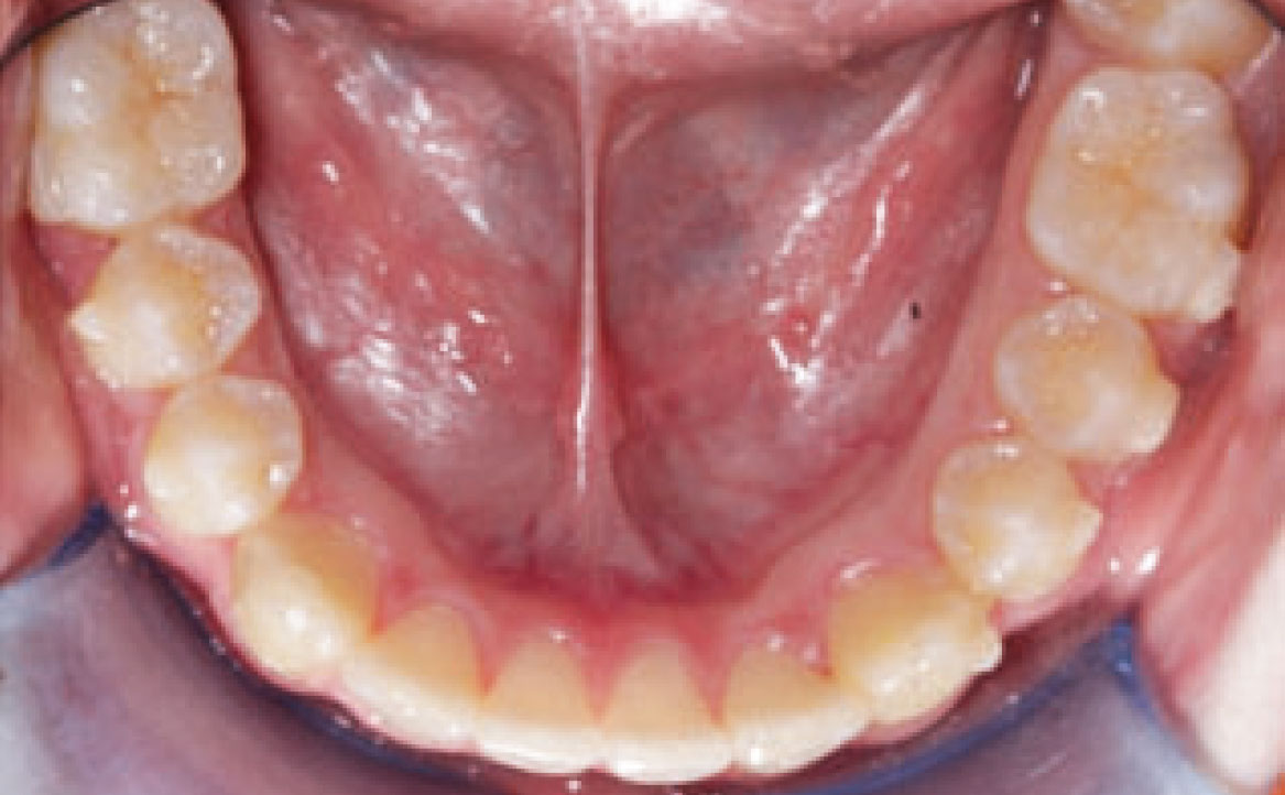 Fig. 9D Foto intraorale finale arcata inferiore.