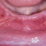 Fig. 7B Caso clinico di paziente che ha sviluppato lesione aftoso-simile a livello della mucosa alveolare in seguito alla assunzione di farmaci antipertenasivi.