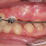 Fig. 9C Dopo 9 mesi dall’inizio del trattamento ortodontico