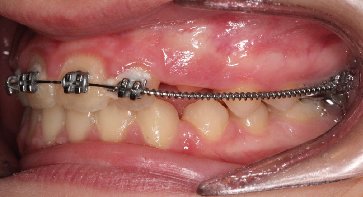 Fig. 9C Dopo 9 mesi dall'inizio del trattamento ortodontico