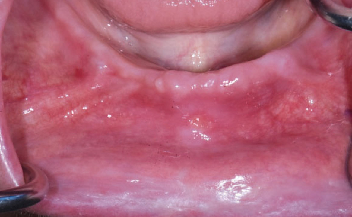 Fig. 7B Caso clinico di paziente che ha sviluppato lesione aftoso-simile a livello della mucosa alveolare in seguito alla assunzione di farmaci antipertenasivi.