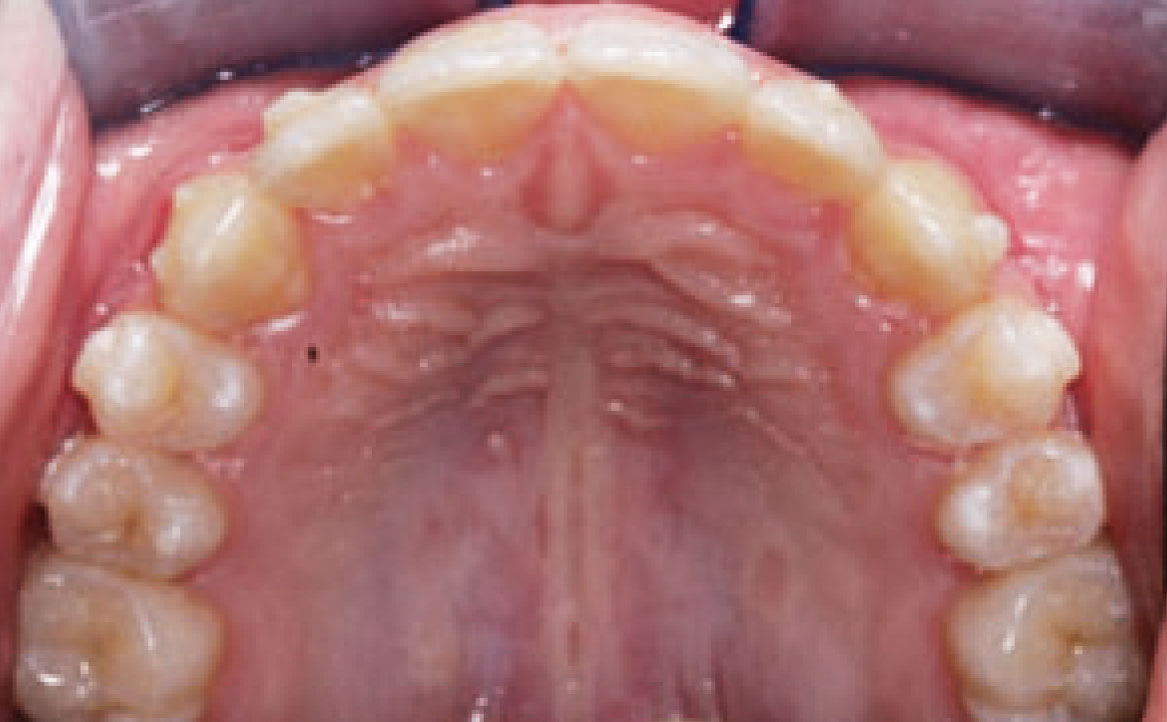 Fig. 9E Foto intraorale finale arcata superiore.
