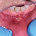 Fig. 7C Caso clinico di paziente che ha sviluppato lesione aftoso-simile a livello della mucosa alveolare in seguito alla assunzione di farmaci antipertenasivi.