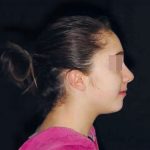 Fig. 22 Fotografia extra orale finale: profilo.