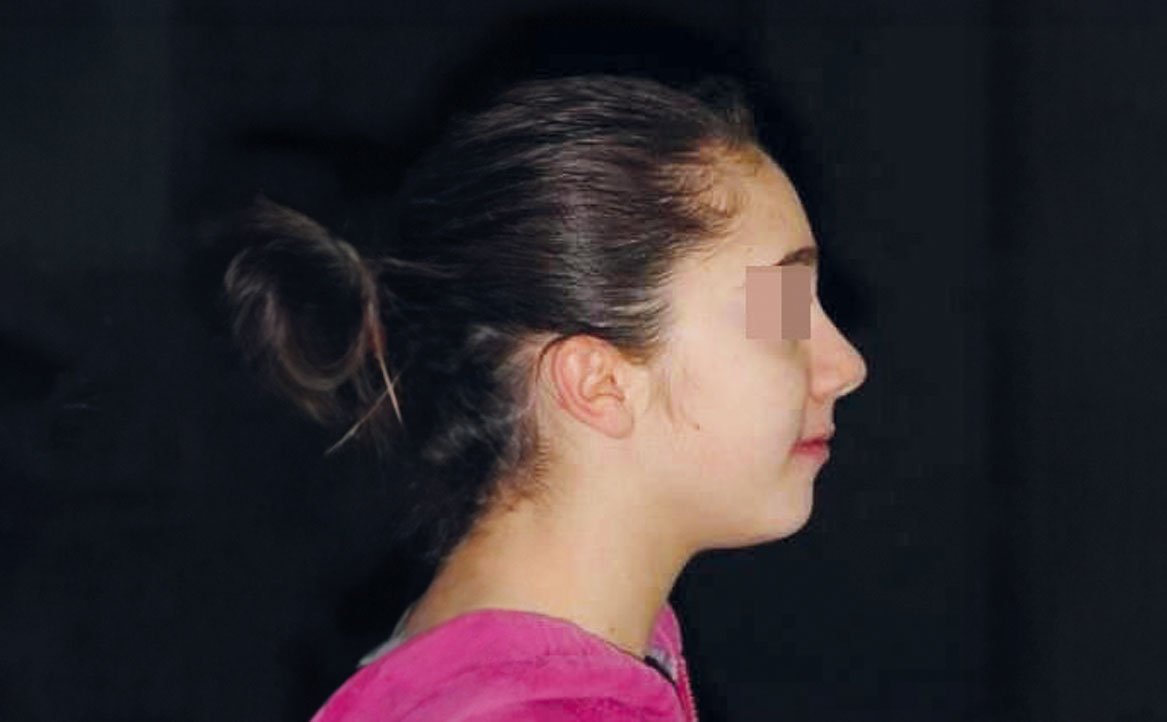 Fig. 22 Fotografia extra orale finale: profilo.