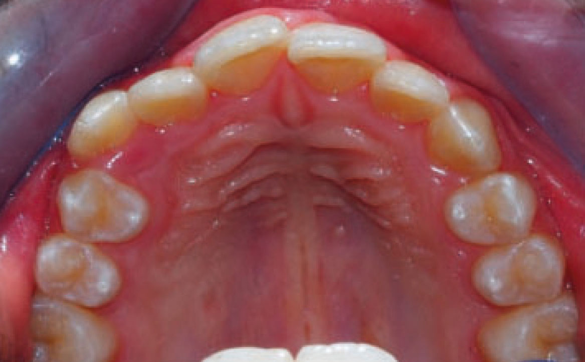 Fig. 5E Foto intraorale arcata superiore.