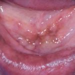 Fig. 8A Caso clinico di paziente con lesioni pigmentate relate all’assunzione di idrossiclorochina, presenti come macchie localizzate a vermiglio delle labbra e dorso lingua.