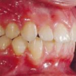 Fig. 23 Fotografia intra orale finale: laterale destra.