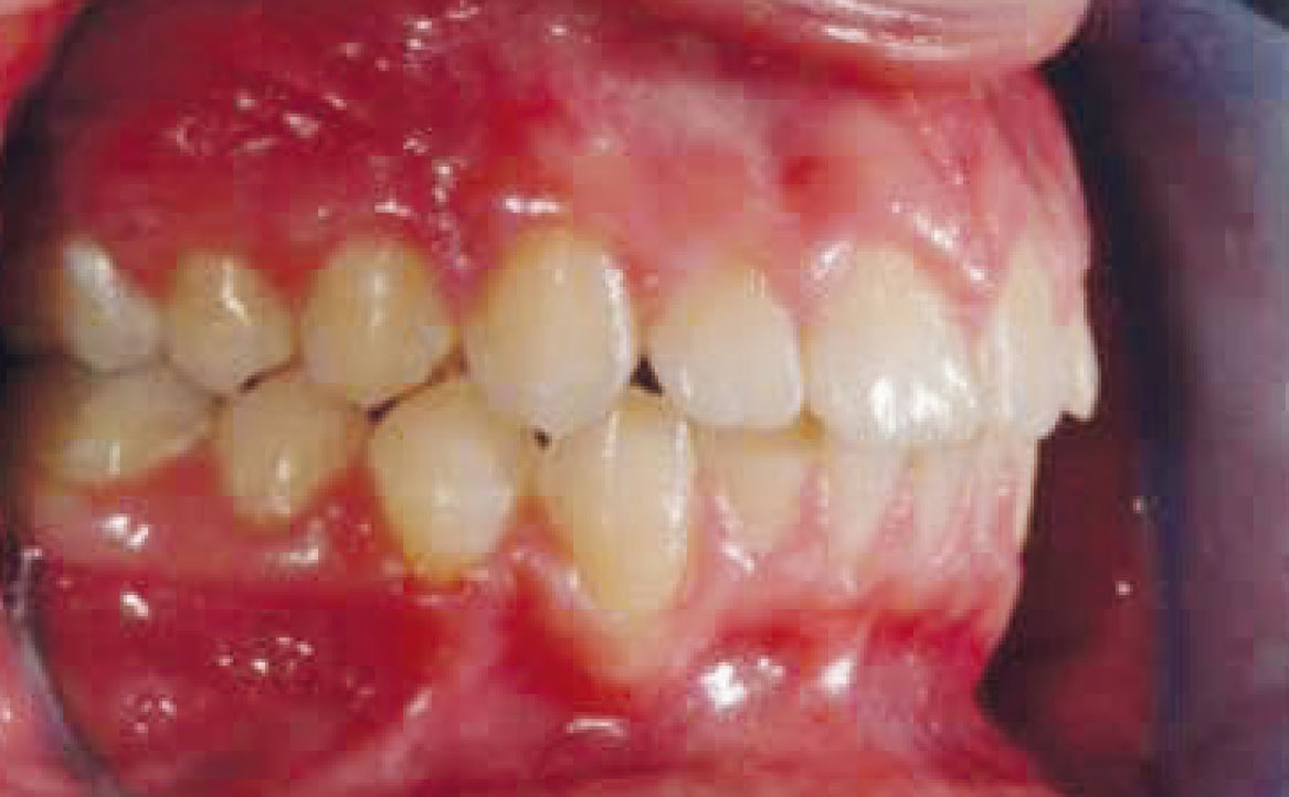 Fig. 23 Fotografia intra orale finale: laterale destra.