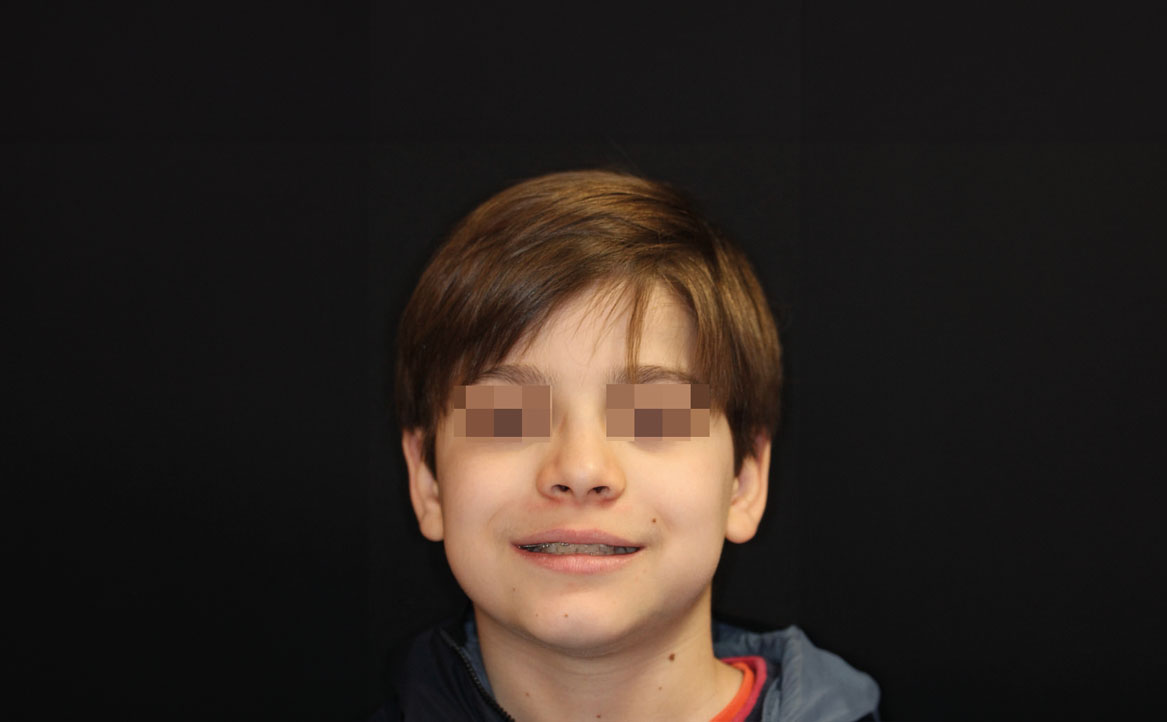 Fig. 9E Dopo 9 mesi dall'inizio del trattamento ortodontico