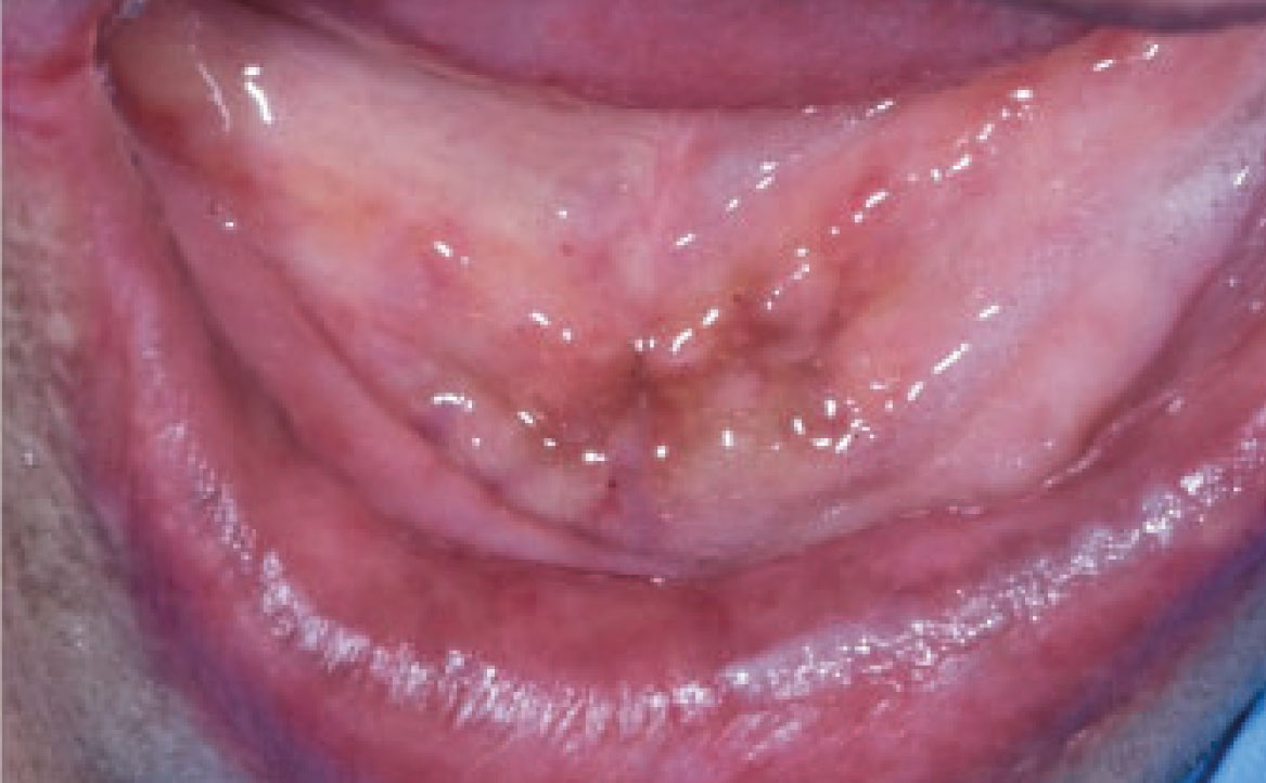Fig. 8A Caso clinico di paziente con lesioni pigmentate relate all’assunzione di idrossiclorochina, presenti come macchie localizzate a vermiglio delle labbra e dorso lingua.