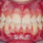 Fig. 24 Fotografia intra orale finale: frontale.