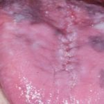 Fig. 8B Caso clinico di paziente con lesioni pigmentate relate all’assunzione di idrossiclorochina, presenti come macchie localizzate a vermiglio delle labbra e dorso lingua.