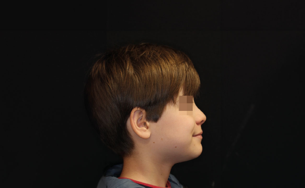 Fig. 9F Dopo 9 mesi dall'inizio del trattamento ortodontico