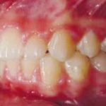 Fig. 25 Fotografia intra orale finale: laterale sinistra.