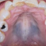 Fig. 9 Pigmentazione simmetrica e diffusa del palato duro di colore bluastro indotta da Imatinib.