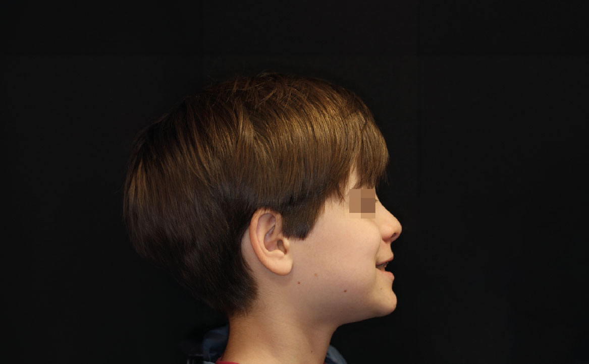 Fig. 9G Dopo 9 mesi dall'inizio del trattamento ortodontico