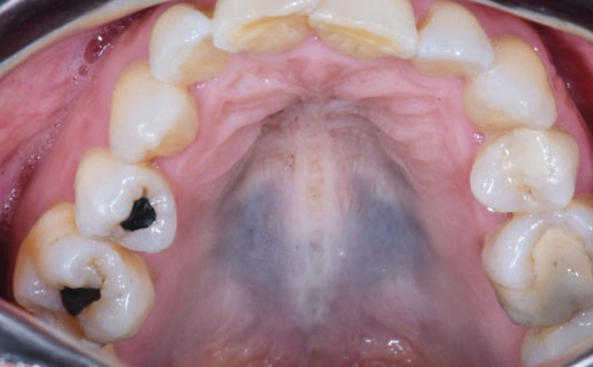 Fig. 9 Pigmentazione simmetrica e diffusa del palato duro di colore bluastro indotta da Imatinib.