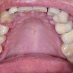 Fig. 10A Caso clinico di aumento di volume gengivale indotto dalla assunzione di amlodipina (calcio-antagonista).