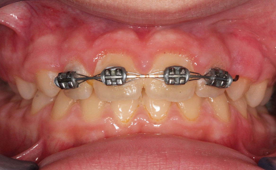 Fig. 10A Dopo 12 mesi dall'inizio del trattamento ortodontico.