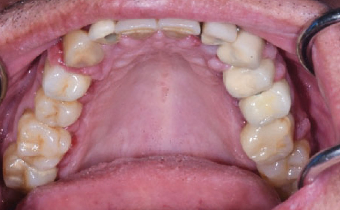 Fig. 10A Caso clinico di aumento di volume gengivale indotto dalla assunzione di amlodipina (calcio-antagonista).