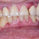 Fig. 10B Caso clinico di aumento di volume gengivale indotto dalla assunzione di amlodipina (calcio-antagonista).