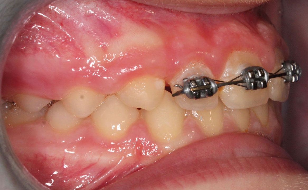 Fig. 10B Dopo 12 mesi dall'inizio del trattamento ortodontico.