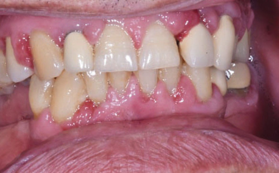 Fig. 10B Caso clinico di aumento di volume gengivale indotto dalla assunzione di amlodipina (calcio-antagonista).