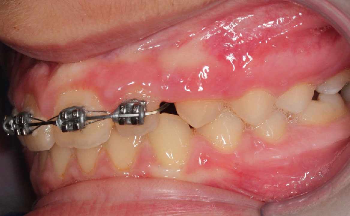 Fig. 10C Dopo 12 mesi dall'inizio del trattamento ortodontico.