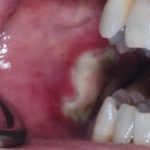 Fig. 11A Caso clinico di mucosite orale indotto dalla assunzione di cis-platino, caratterizzato dalla presenza di ulcerazioni e necrosi tissutale diffusa.