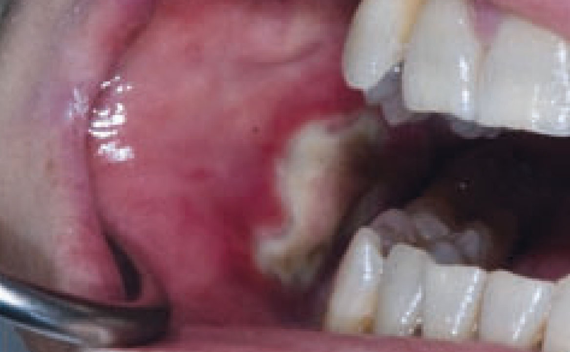 Fig. 11A Caso clinico di mucosite orale indotto dalla assunzione di cis-platino, caratterizzato dalla presenza di ulcerazioni e necrosi tissutale diffusa.