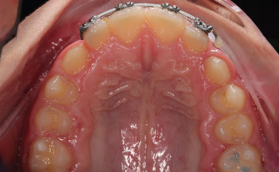 Fig. 10D Dopo 12 mesi dall'inizio del trattamento ortodontico.