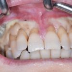 Fig. 11B Caso clinico di mucosite orale indotto dalla assunzione di cis-platino, caratterizzato dalla presenza di ulcerazioni e necrosi tissutale diffusa.