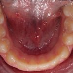 Fig. 10E Dopo 12 mesi dall’inizio del trattamento ortodontico.