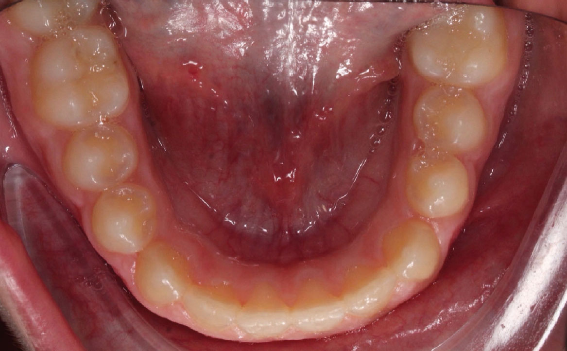 Fig. 10E Dopo 12 mesi dall'inizio del trattamento ortodontico.
