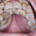 Fig. 11C Caso clinico di mucosite orale indotto dalla assunzione di cis-platino, caratterizzato dalla presenza di ulcerazioni e necrosi tissutale diffusa.