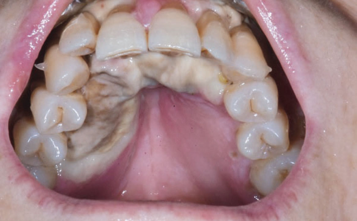 Fig. 11C Caso clinico di mucosite orale indotto dalla assunzione di cis-platino, caratterizzato dalla presenza di ulcerazioni e necrosi tissutale diffusa.
