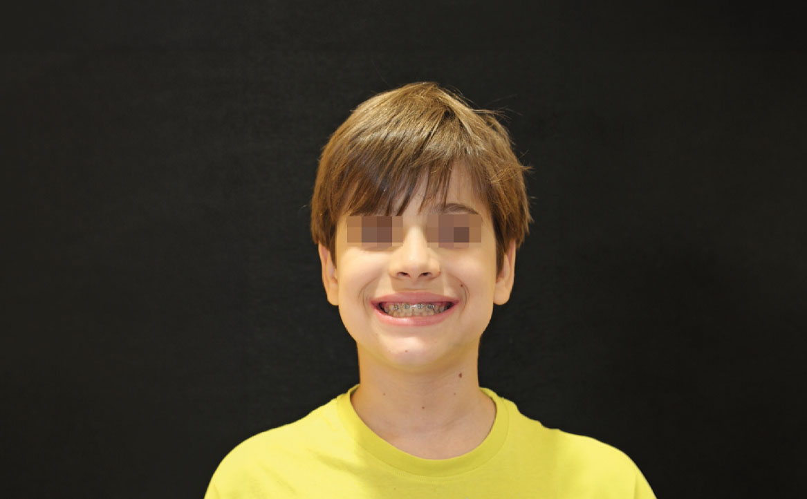 Fig. 10F Dopo 12 mesi dall'inizio del trattamento ortodontico.