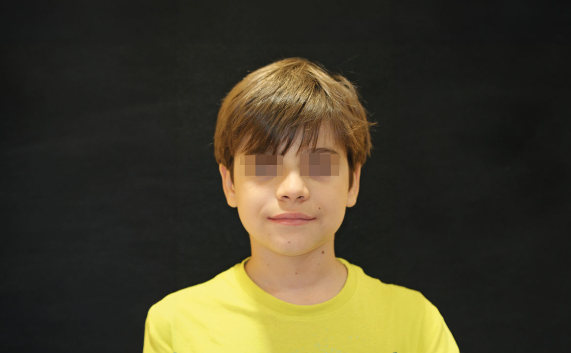 Fig. 10G Dopo 12 mesi dall'inizio del trattamento ortodontico.