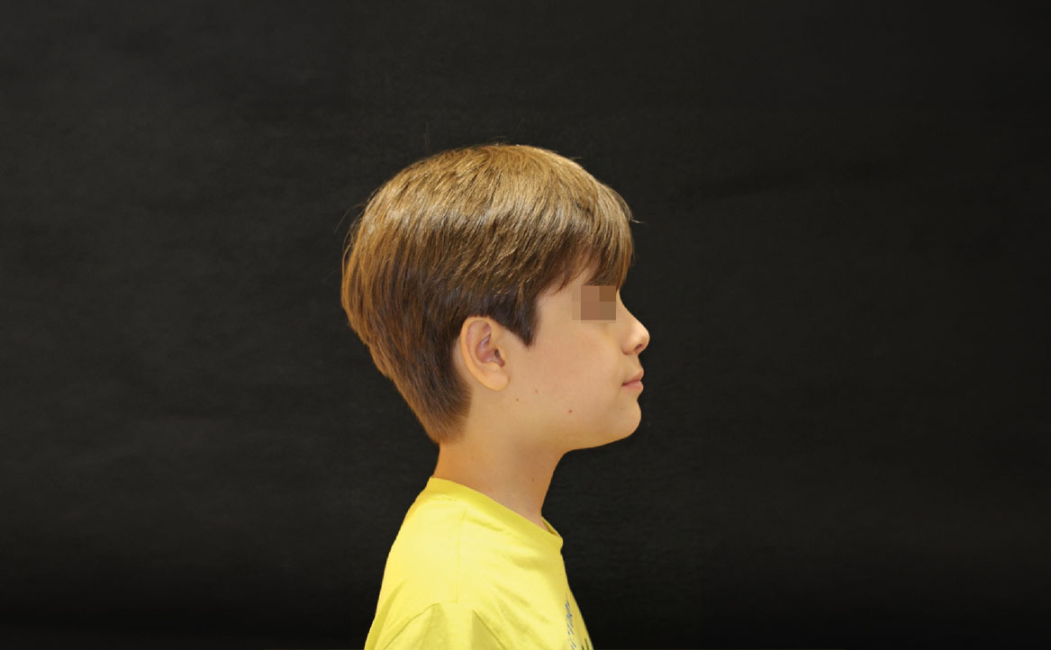 Fig. 10H Dopo 12 mesi dall'inizio del trattamento ortodontico.