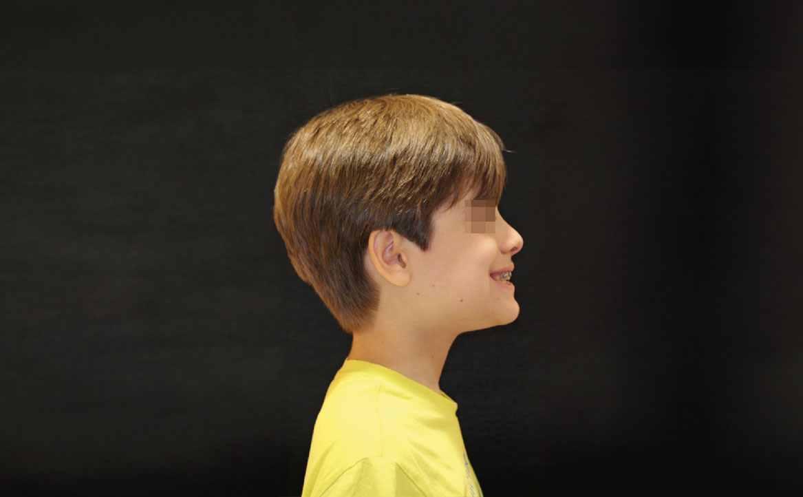 Fig. 10I Dopo 12 mesi dall'inizio del trattamento ortodontico.