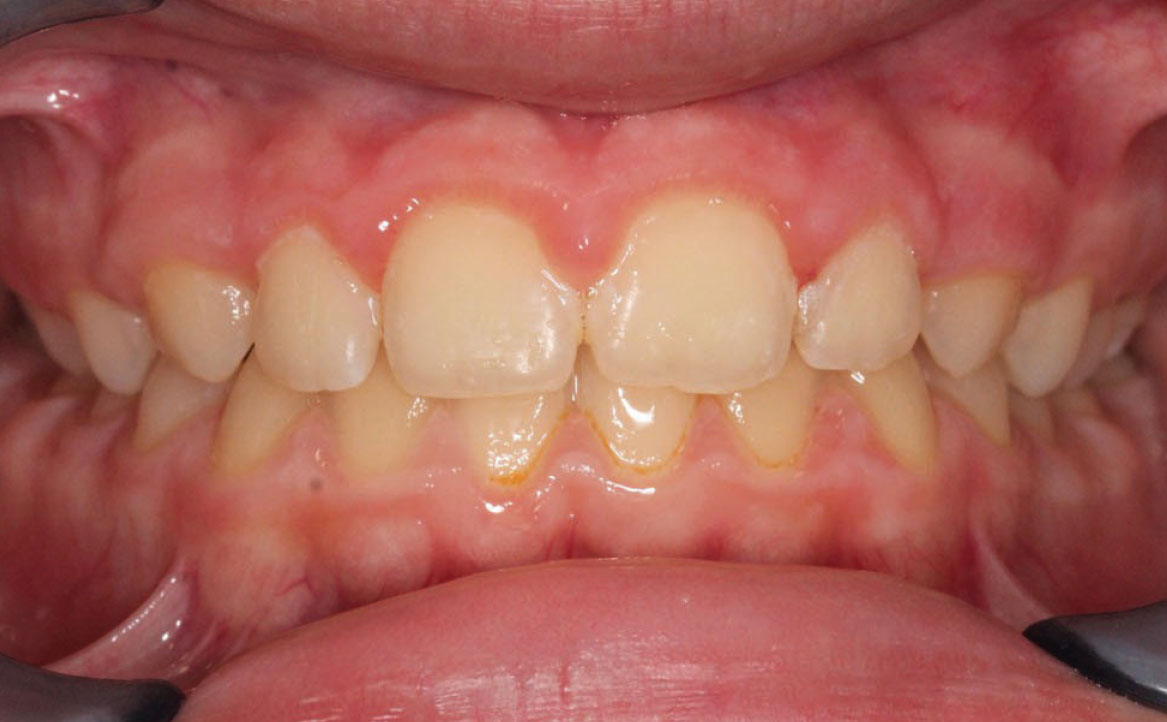 Fig. 11A Correzione della pseudo-classe III a fine trattamento.