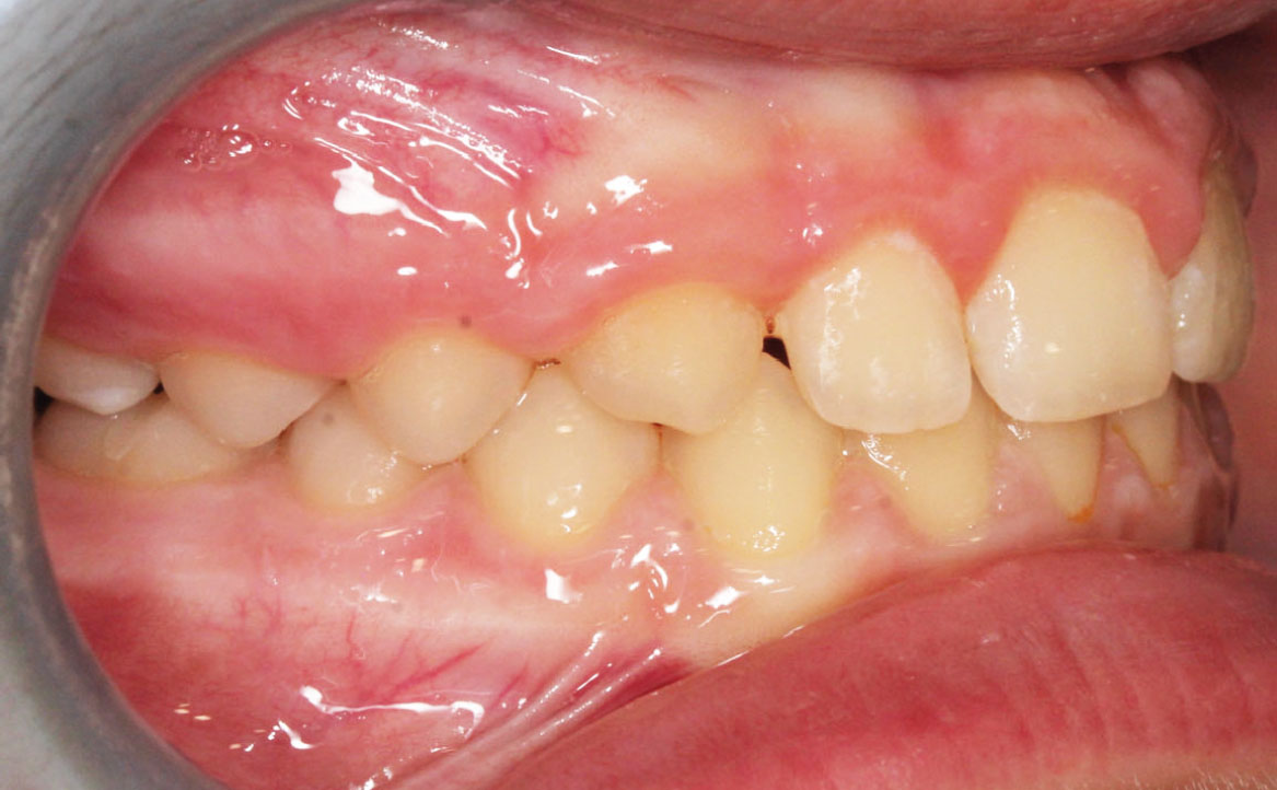 Fig. 11B Correzione della pseudo-classe III a fine trattamento.
