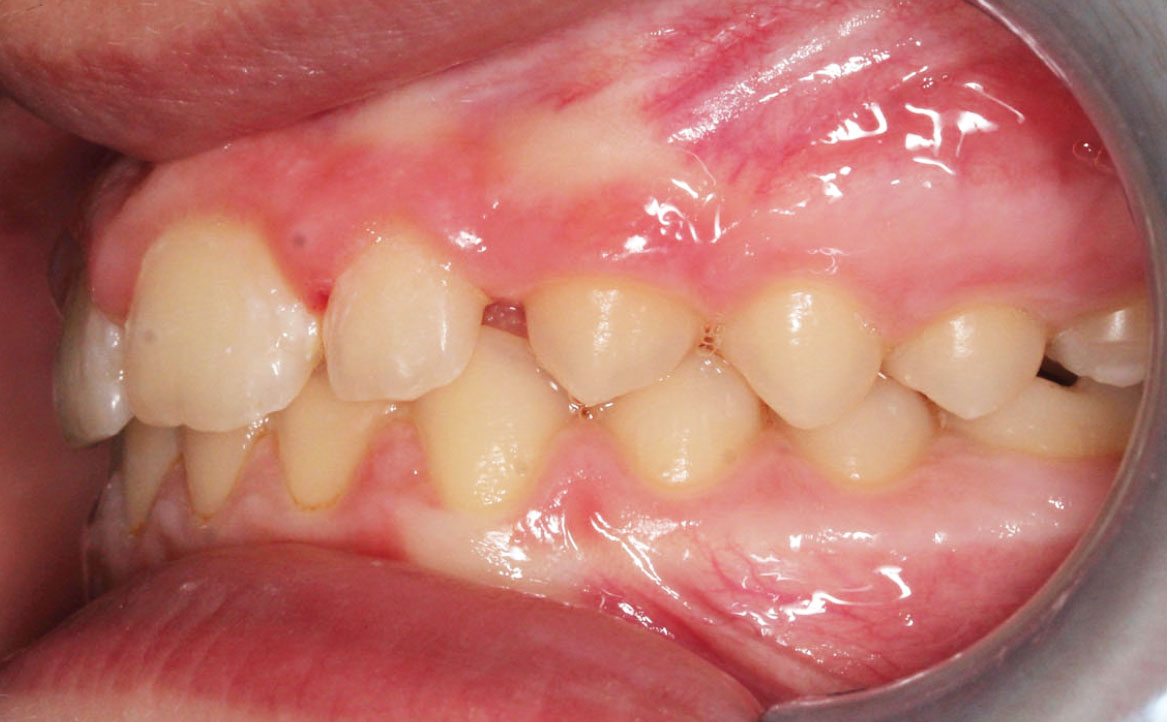 Fig. 11C Correzione della pseudo-classe III a fine trattamento.