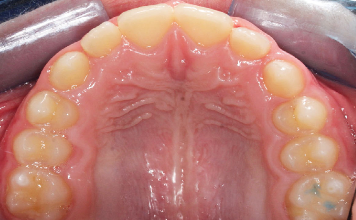 Fig. 11D Correzione della pseudo-classe III a fine trattamento.
