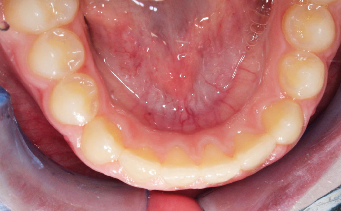 Fig. 11E Correzione della pseudo-classe III a fine trattamento.