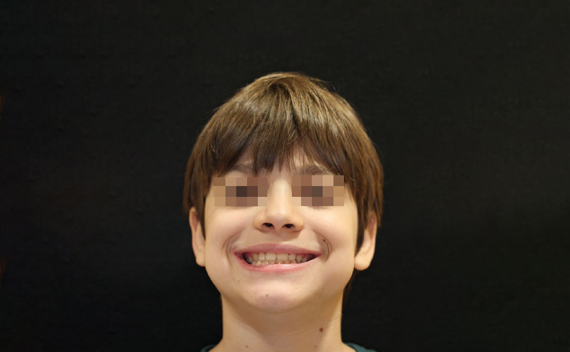 Fig. 11F Correzione della pseudo-classe III a fine trattamento.